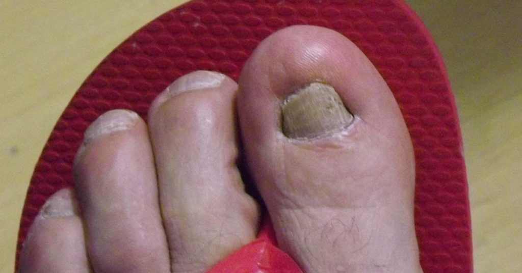 Micose nas Unhas